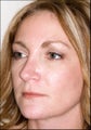 Revision rhinoplasty