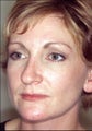 Revision rhinoplasty