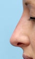 Facial Dermafillers