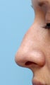 Facial Dermafillers