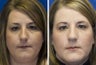 Female rhinoplasty
