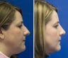 Female rhinoplasty