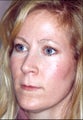 Rhinoplasty