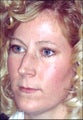 Rhinoplasty