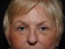 Upper Lid Eyelid Surgery