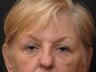 Upper Lid Eyelid Surgery