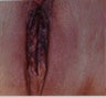 Vaginal Rejuvenation & Labiaplasty