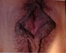 Vaginal Rejuvenation & Labiaplasty
