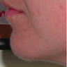 Chin Implant