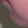 Chin Implant