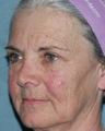 Female Patient Has Fraxel Repair