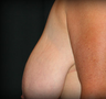 Breast Lift