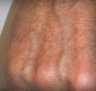 Sunspot Treatment