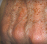 Sunspot Treatment