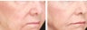 Lifting of cheeks and nasolabial folds with Radiesse