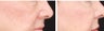 Lifting of cheeks and nasolabial folds with Radiesse