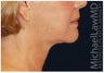Lower Facial Rejuvenation