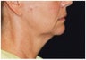 Lower Facial Rejuvenation