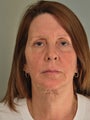 Face/Neck Lift