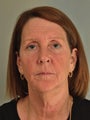 Face/Neck Lift