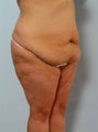 Body Lift