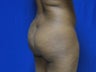 32 year old Brazilian Butt Lift - 2nd view