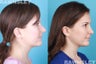 Revision Rhinoplasty