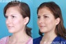 Revision Rhinoplasty