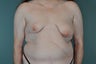 Breast Lift