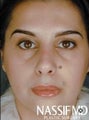 Primary Female Rhinoplasty