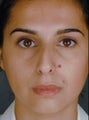 Primary Female Rhinoplasty