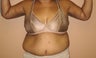 45 y/o female treated for sagging arms