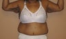 45 y/o female treated for sagging arms