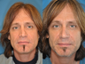47 Year Old Male Treated for Nasal Deformity and Nasal Collapse