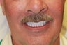 55 year old male treated with All-on-4 Procedure