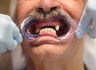 55 year old male treated with All-on-4 Procedure