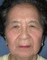 Lateral Browlift & Upper Lid Blepharoplasty
