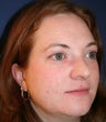 Acne Scar Improvement
