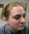 Acne Scar Improvement