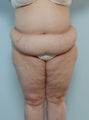 Body Lift