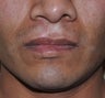 32 Year Old Male Treated For A Cleft Lip