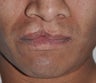 32 Year Old Male Treated For A Cleft Lip
