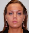 HA Filler under the eyes/ Teartrough