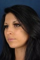 21 Year Old Female - Facial Fillers
