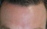 Male Botox Patient