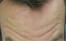 Male Botox Patient