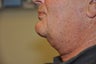 Necklift