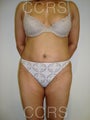 VASER lipo with Mini TT, 35 yrs. old female