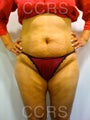 VASER lipo with Mini TT, 35 yrs. old female
