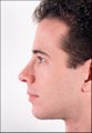 Rhinoplasty and Chin Implant